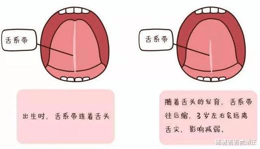 孩子舌头短怎么办