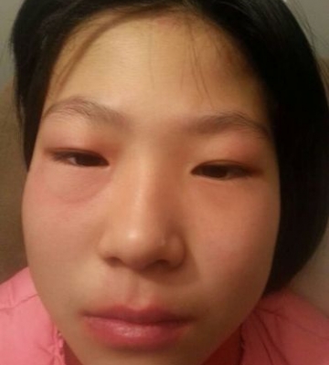 孩子眼皮红肿怎么回事
