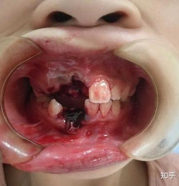 孩子门牙磕断了怎么办