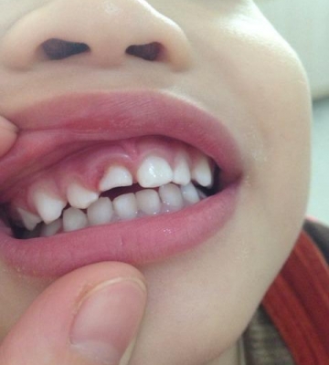 孩子牙龈红肿怎么办