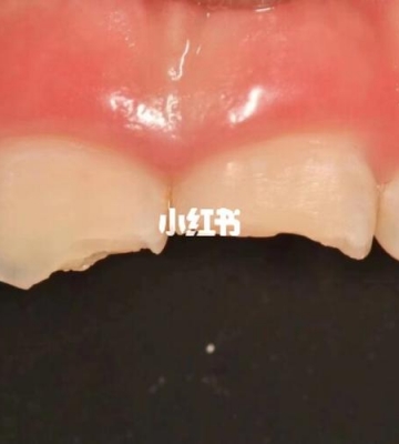 孩子门牙磕松了怎么办