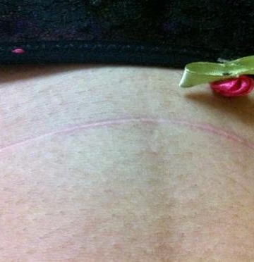 疤痕体质生孩子怎么办