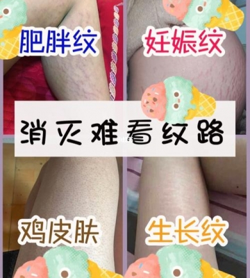 生完孩子妊娠纹怎么去掉