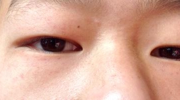 孩子眼袋发红怎么回事