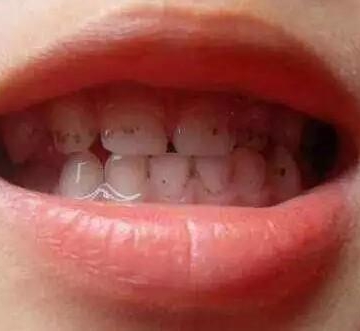 孩子牙齿色素沉着怎么去除