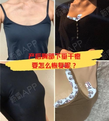 生完孩子胸部下垂怎么办