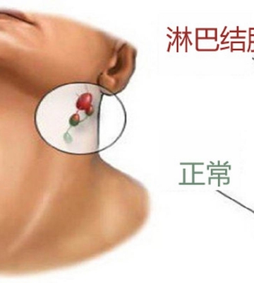 孩子淋巴结肿大怎么办