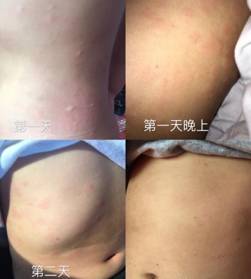 小孩子蛋白质过敏怎么办