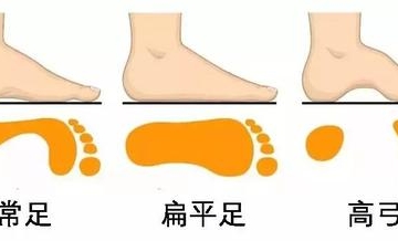 孩子扁平足怎么办