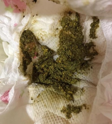孩子拉不出来粑粑怎么办