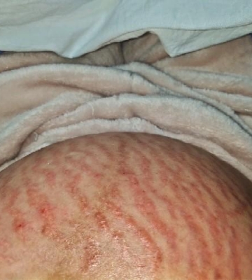 生完孩子妊娠纹怎么消除