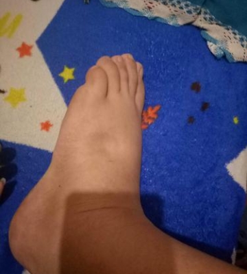 孩子脚肿了怎么办