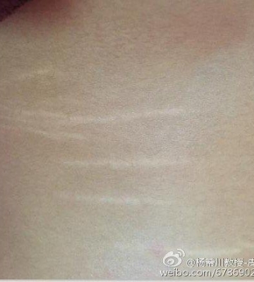 女人的肥胖纹可以通过运动消失