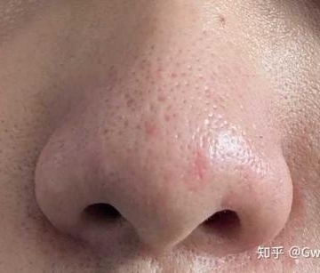 小孩子鼻子有黑头怎么办