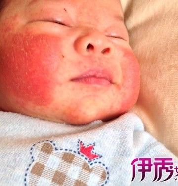 孩子有湿疹怎么办