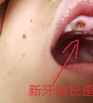 小孩子牙齿长歪了怎么办
