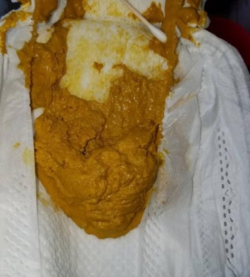 小孩子拉不出来屎怎么办
