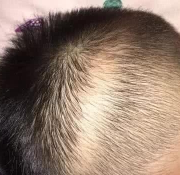 孩子枕秃怎么办