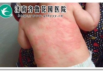 孩子得了湿疹怎么办
