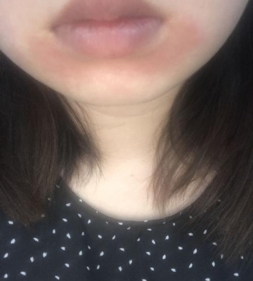 下巴突然痛痒红起东西