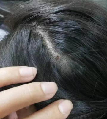 孩子总是头皮痒怎么办