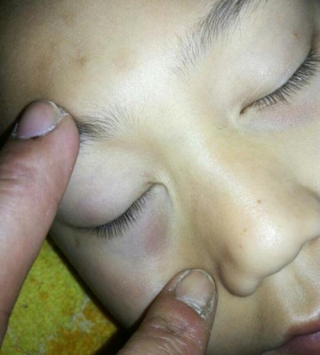 小孩子有眼袋怎么办