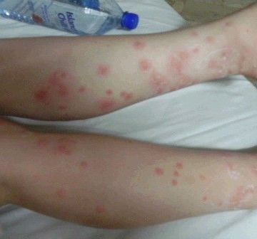 螨虫性湿疹禁吃什么东西