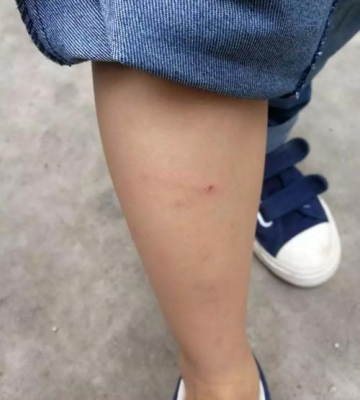 狗被咬伤了不吃东西
