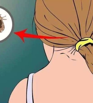 孩子头上有虱子怎么办