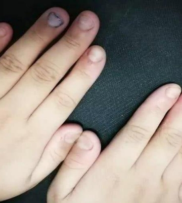 怎么防止孩子咬指甲