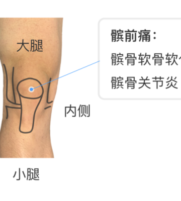 治疗剧烈运动后膝盖疼