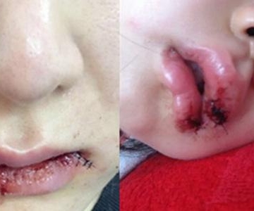 孩子嘴唇磕破了怎么办