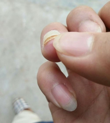 指甲扎进东西怎么办