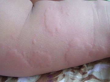 孩子荨麻疹怎么治疗