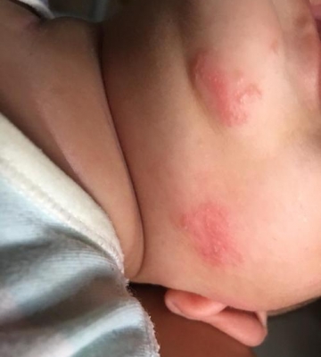 孩子身上起湿疹怎么办