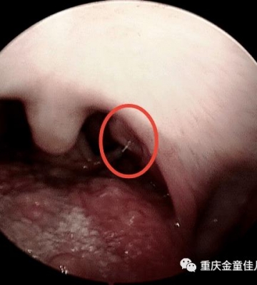 喉咙感觉有东西卡住