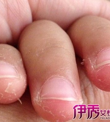 孩子手脚脱皮怎么办