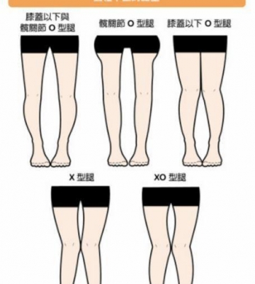 小腿外翻做什么运动