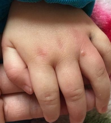 孩子起水泡怎么办
