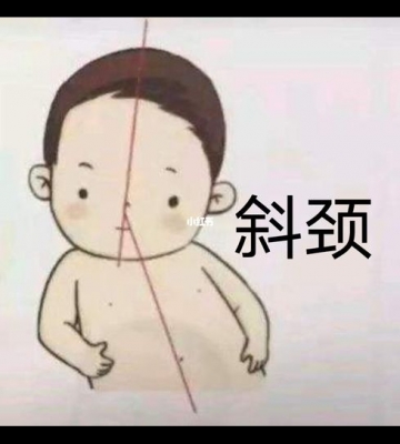 怎么判断孩子是不是斜颈
