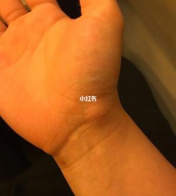 抱孩子手腕疼怎么缓解