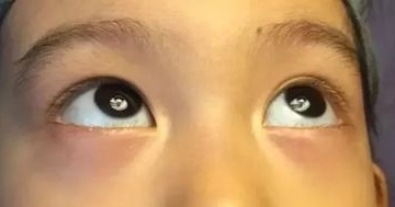 孩子有眼袋怎么办