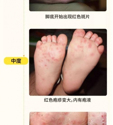小孩子得了手足口病怎么办