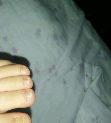 小孩子灰指甲怎么办