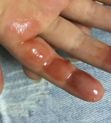 小孩子手被烫伤了怎么办
