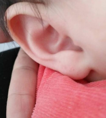 孩子耳朵红怎么回事
