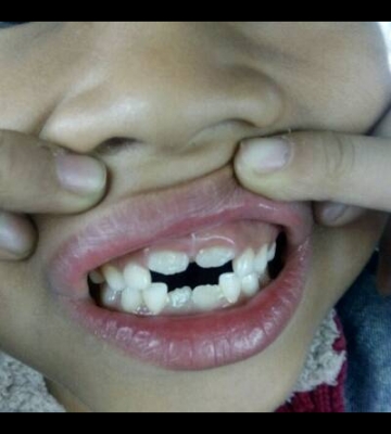 孩子门牙大怎么办