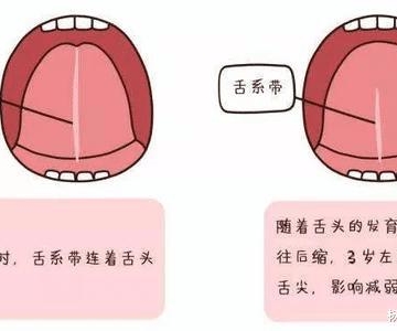 孩子舌头短怎么办