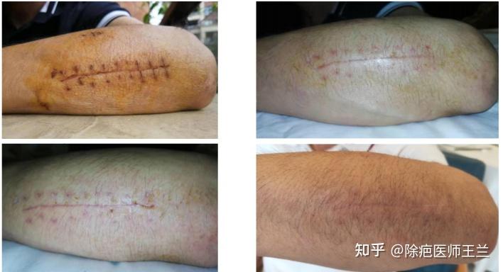 如何避免皮肤疤痕