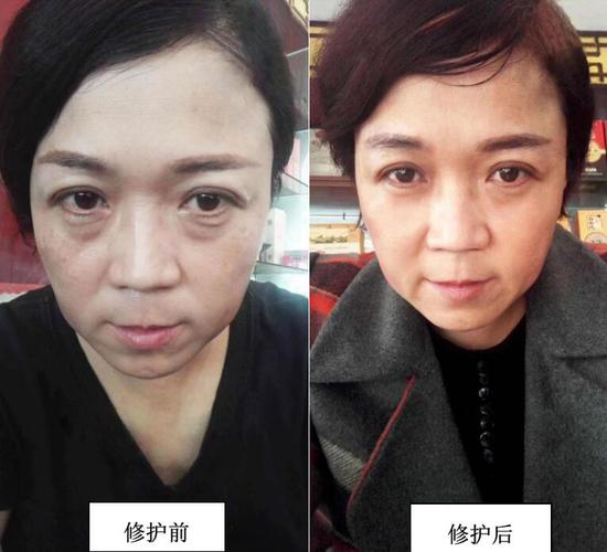 如何消除眼袋